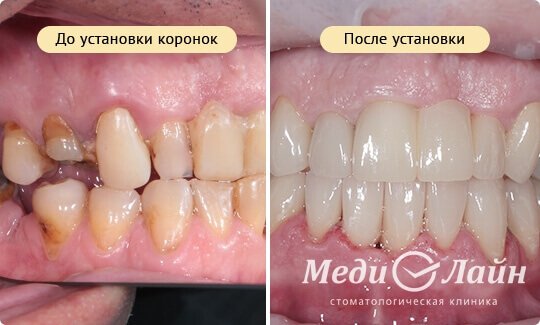 Как моделируется зубы Как моделируется зубы