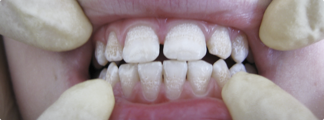 Аномалий цвета зубов лечение