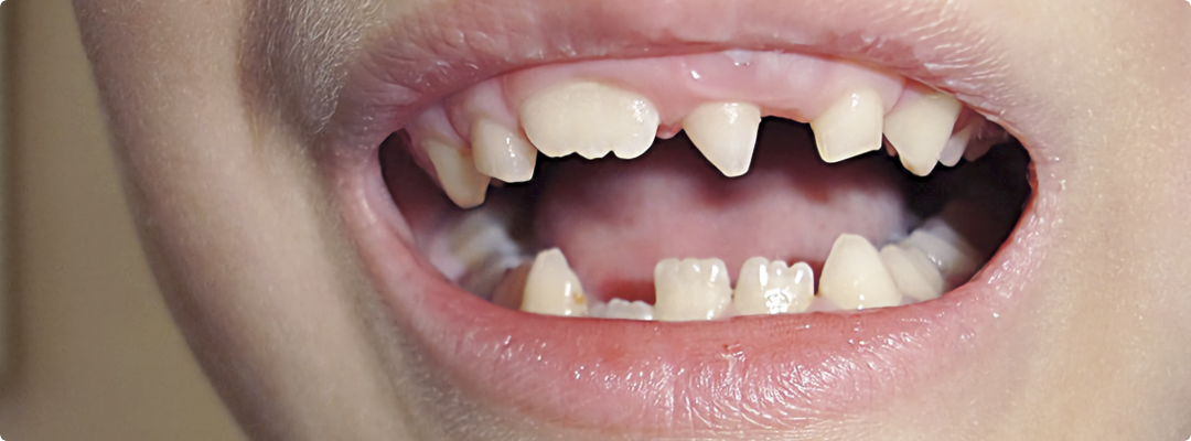Аномалий цвета зубов лечение thumbnail