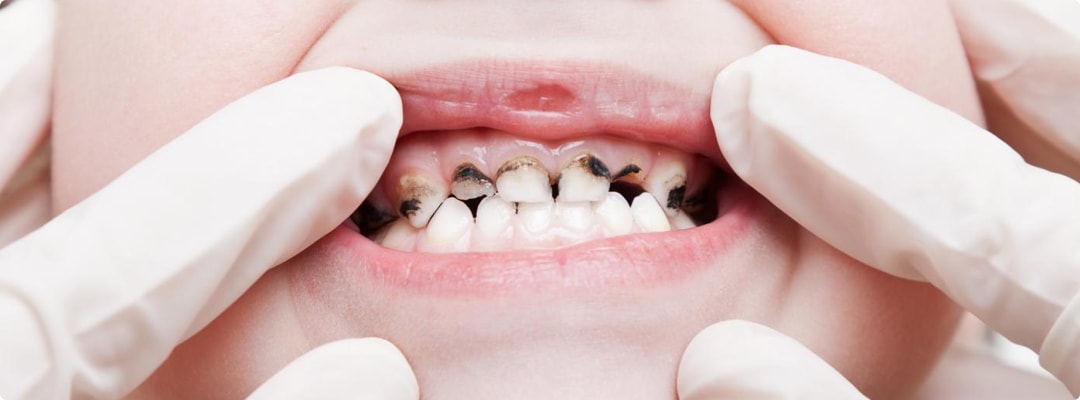 Темные зубы у детей