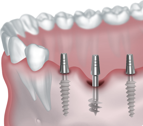 Зубные имплантаты