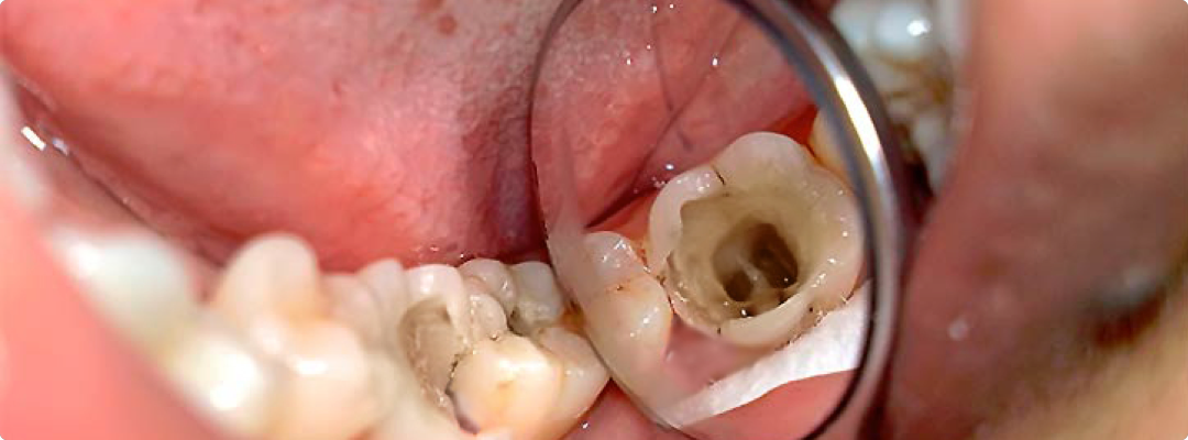 Особенности лечения зубных каналов