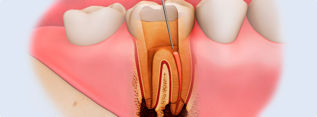 Лечение пульпита