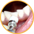 Профессиональная гигиена полости рта с удалением мягкого налета