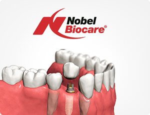 Приживление имплантов, установка зубных имплантов