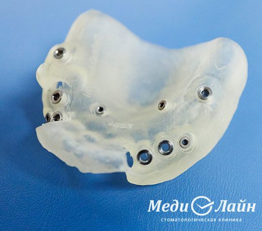 Создание хирургического шаблона, ортопедическая стоматология