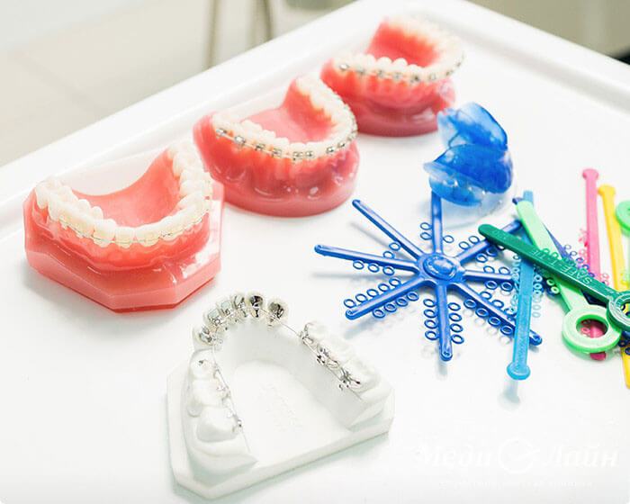 Выравнивание зубов брекетами, клиника Медилайн