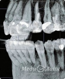 Трехмерный рентгеновский снимок