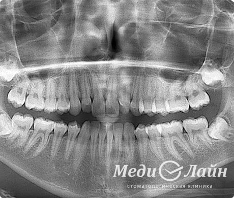 Панорамный снимок челюстей