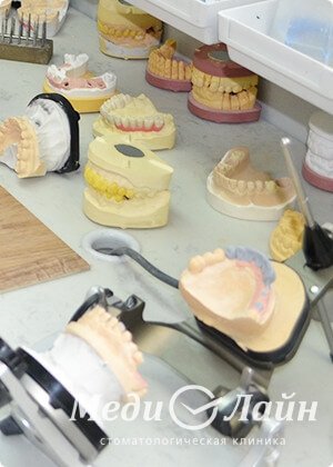 Сканирование зубов или оттиск челюстей для создания точной ортодонтической конструкции
