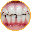 В результате воздействия малых сил костная ткань, окружающая корень зуба, рассасывается