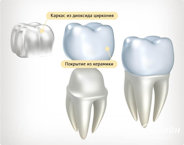 Коронки из диоксида циркония