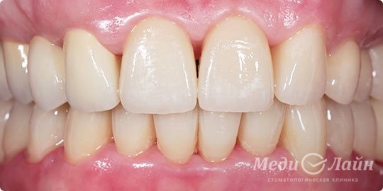 Снимок сомкнутых зубов