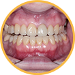 Снимки сомкнутых зубов с ретрактором