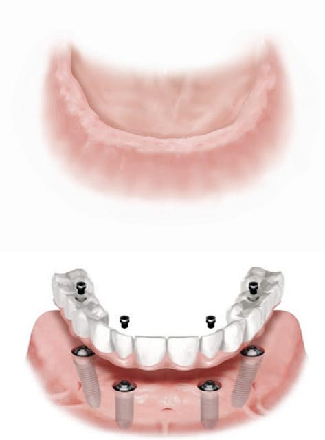 Особенности протезирования All-оn-4 при адентии