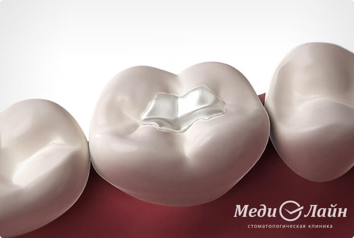 Вкладки в зубы в Ульяновске